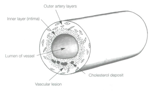 Vadcular disease introduction graph 3